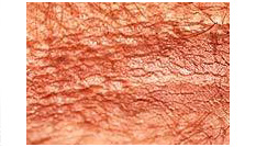 acanthosis nigricans