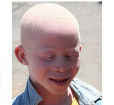 child with albinism