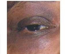 periorbital_hyperpigmentation