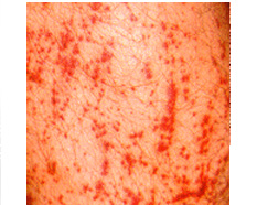 phytophotodermatitis