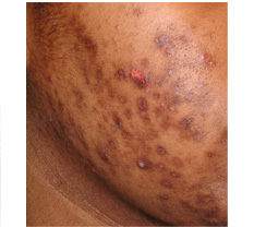 postinflammatory hyperpigmentation