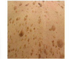 seborrheic keratoses