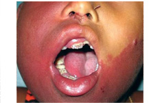 sturge weber syndrome