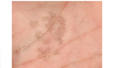 Pigmentary Disorders > Tinea Nigra / Tinea Versicolor / Pityriasis